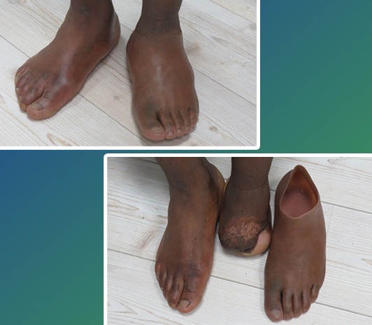 Foot Restorations - ALTERNATIVE PROSTHETIC SERVICES